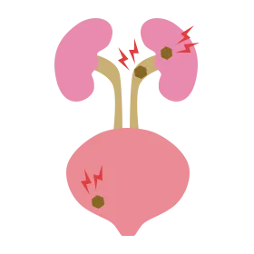 尿路結石